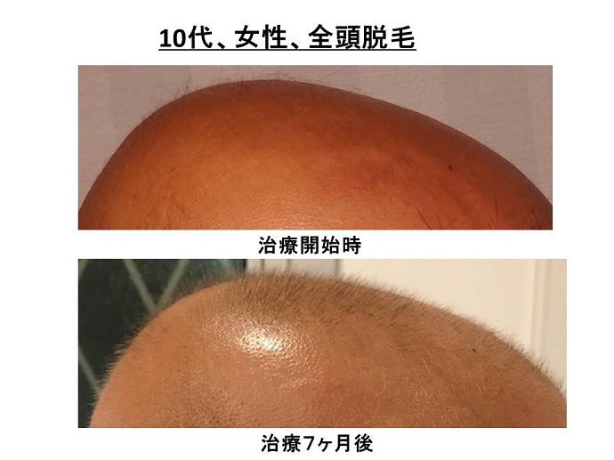 円形脱毛症　病院